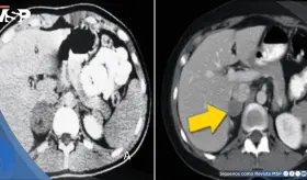 Cefalea intensa, rubor facial e hipertensión grave en adolescente revelan diagnóstico de feocromocitoma