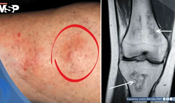 Nudos en extremidad revelan lupus y síndrome antifosfolípido en mujer con inflamación articular y úlceras