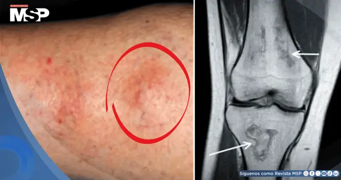 Nudos en extremidad revelan lupus y síndrome antifosfolípido en mujer con inflamación articular y úlceras