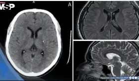 Paciente desarrolla migraña hemipléjica con parálisis temporal tras años de dolores de cabeza leves