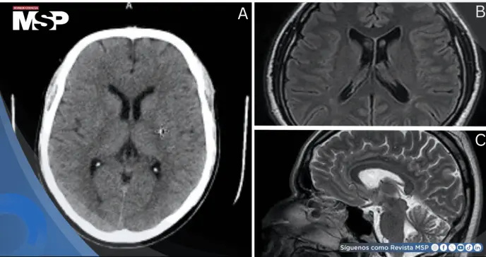 Paciente desarrolla migraña hemipléjica con parálisis temporal tras años de dolores de cabeza leves