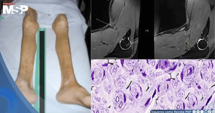 Tras infección respiratoria, paciente presentó dificultad para caminar y pérdida de equilibrio