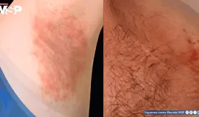 Hombre con obesidad presenta alergia a químico de ropa deportiva con erupción y prueba de parche positiva