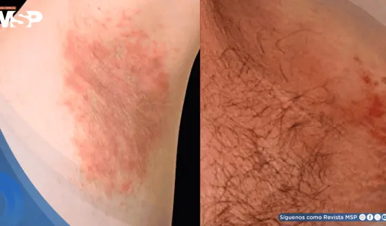 Hombre con obesidad presenta alergia a químico de ropa deportiva con erupción y prueba de parche positiva