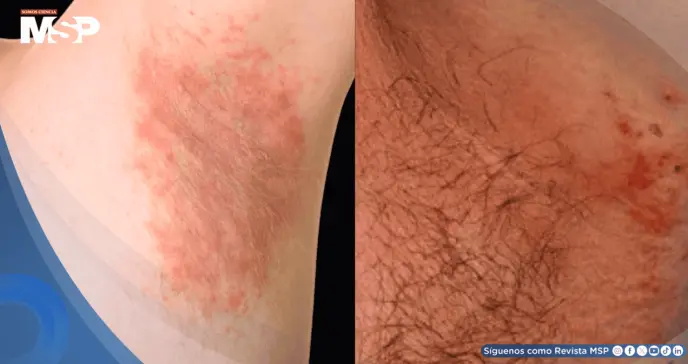 Hombre con obesidad presenta alergia a químico de ropa deportiva con erupción y prueba de parche positiva