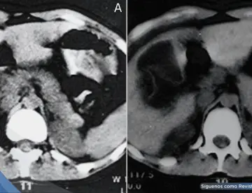 Quiste hidátido hepático se rompe tras abrazo de oso: Paciente desarrolla dolor abdominal y urticaria