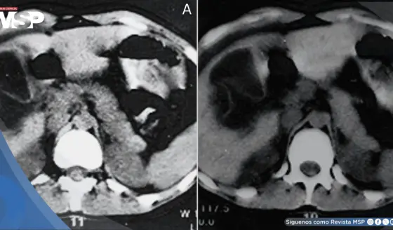 Quiste hidátido hepático se rompe tras abrazo de oso: Paciente desarrolla dolor abdominal y urticaria