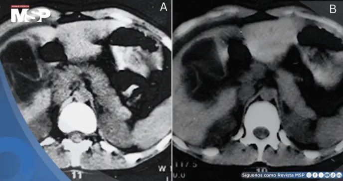 Quiste hidátido hepático se rompe tras abrazo de oso: Paciente desarrolla dolor abdominal y urticaria
