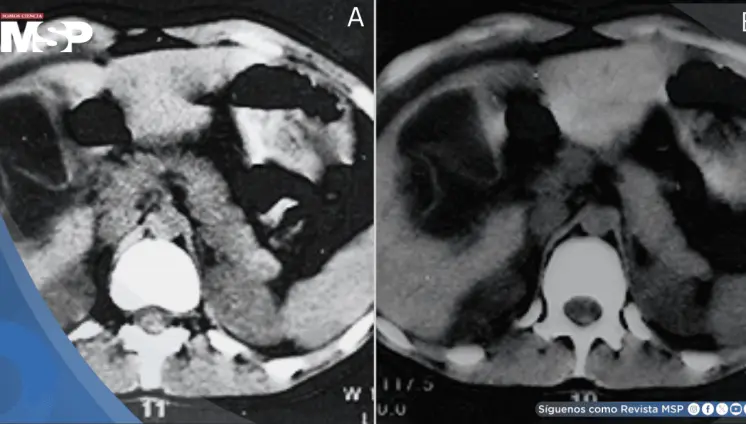 Quiste hidátido hepático se rompe tras 