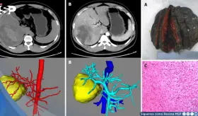 Infarto hepático en joven con dolor abdominal y fiebre simulaba tumor hemorrágico