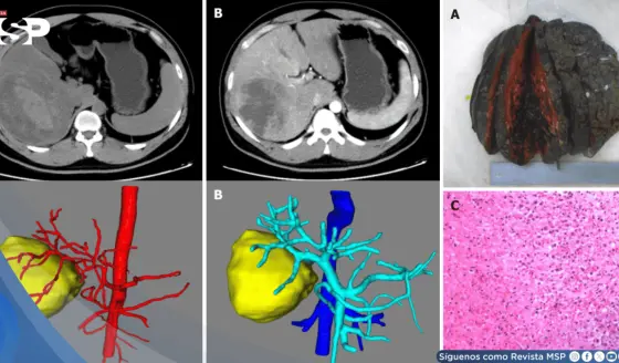 Infarto hepático en joven con dolor abdominal y fiebre simulaba tumor hemorrágico