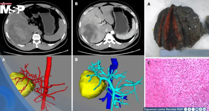 Infarto hepático en joven con dolor abdominal y fiebre simulaba tumor hemorrágico