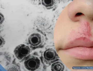 Desarrollan un nuevo antiviral efectivo contra cepas resistentes del virus del herpes