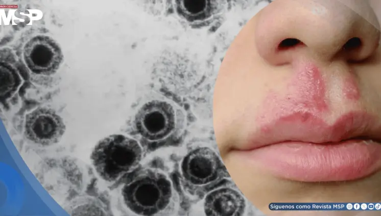 Desarrollan un nuevo antiviral efectivo contra cepas resistentes del virus del herpes