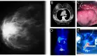 Carcinoma mamario triple negativo y adenocarcinoma rectal sincrónico en paciente con BRCA1 y hepatitis B