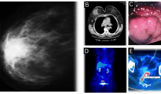 Carcinoma mamario triple negativo y adenocarcinoma rectal sincrónico en paciente con BRCA1 y hepatitis B

