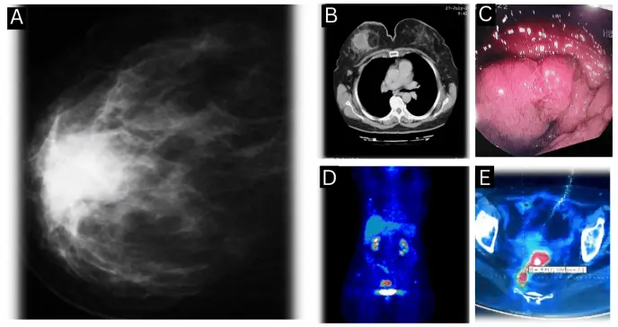 Carcinoma mamario triple negativo y adenocarcinoma rectal sincrónico en paciente con BRCA1 y hepatitis B