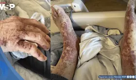 Hombre desarrolla vasculitis cutánea tras 6 semanas de tratamiento con apixabán por fibrilación auricular