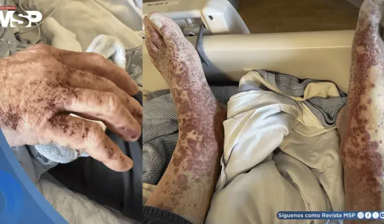 Hombre desarrolla vasculitis cutánea tras 6 semanas de tratamiento con apixabán por fibrilación auricular