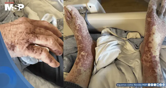 Hombre desarrolla vasculitis cutánea tras 6 semanas de tratamiento con apixabán por fibrilación auricular