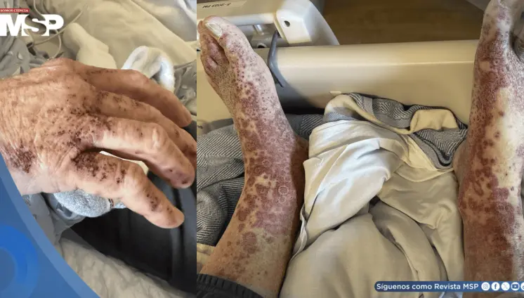 Hombre desarrolla vasculitis cutánea tras 6 semanas de tratamiento con apixabán por fibrilación auricular