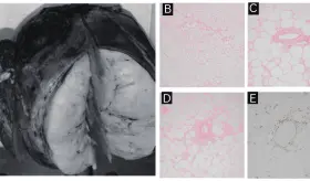Detección incidental de lipoma uterino intramural en mujer posmenopáusica por infecciones urinarias