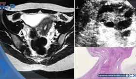 Sofoco y ausencia de menstruación revela trastorno autoinmune que afectó ovarios y causó hipotiroidismo