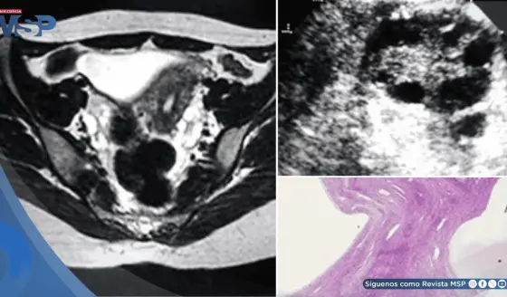 Sofoco y ausencia de menstruación revela trastorno autoinmune que afectó ovarios y causó hipotiroidismo
