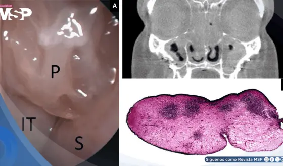Poliposis nasal bilateral, anosmia y crisis asmáticas desencadenadas por AINEs y aspirina
