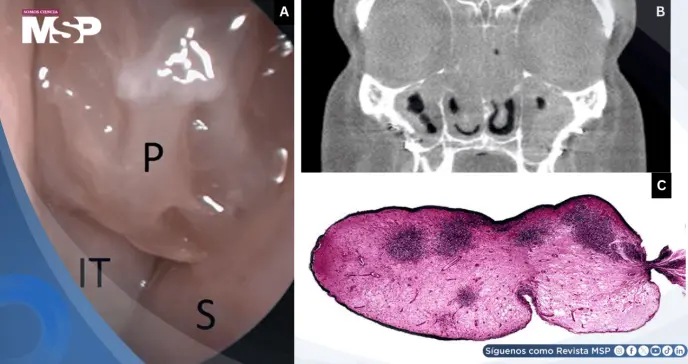 Poliposis nasal bilateral, anosmia y crisis asmáticas desencadenadas por AINEs y aspirina
