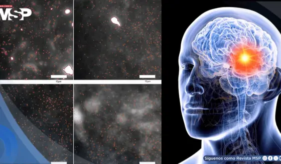 Detectan por primera vez los oligómeros de alfa-sinucleína, proteínas que marcan el inicio del párkinson