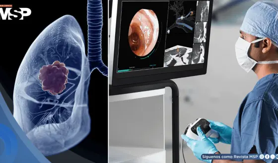 Nueva broncoscopia asistida por robot alcanza tumores pequeños en zonas profundas del pulmón
