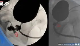 Sonda urinaria ocasiona fístula rectourinaria en paciente con intercambio anormal de fluidos