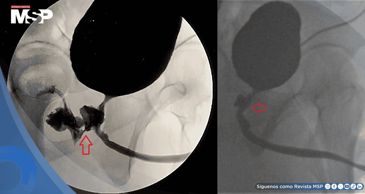 Sonda urinaria ocasiona fístula rectourinaria en paciente con intercambio anormal de fluidos