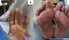 Reportan primer caso de coinfección por Mpox y VIH avanzado con lesiones pustulares y úlceras vulvares