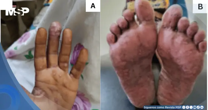 Reportan primer caso de coinfección por Mpox y VIH avanzado con lesiones pustulares y úlceras vulvares