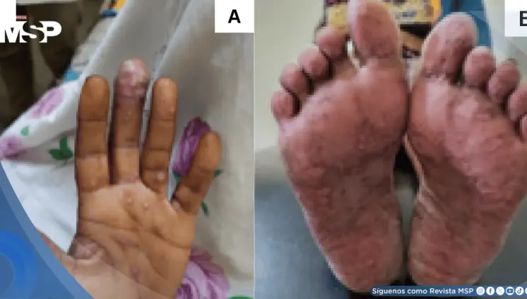 Reportan primer caso de coinfección por Mpox y VIH avanzado con lesiones pustulares y úlceras vulvares Reportan primer caso de coinfección por Mpox y VIH avanzado con lesiones pustulares y úlceras vulvares