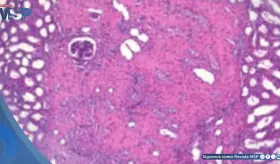 Paciente desarrolla psicosis y alteraciones electrolíticas al consumir bromuro de sodio indicado por IA