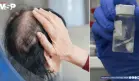 Desarrollan gel experimental que podría prevenir la caída de cabello durante la quimioterapia