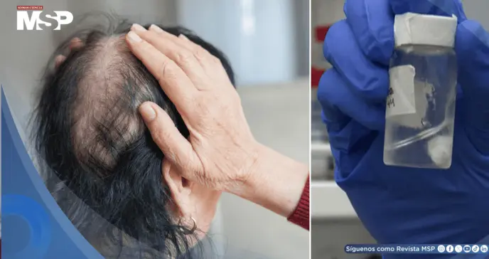 Desarrollan gel experimental que podría prevenir la caída de cabello durante la quimioterapia