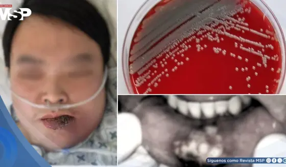 Paciente con diabetes no diagnosticada desarrolla infección facial por bacteria resistente y cetoacidosis