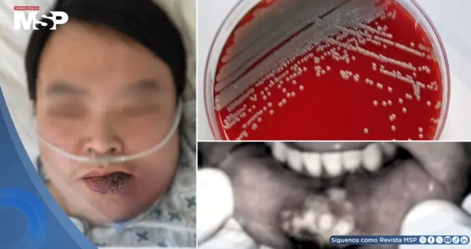 Paciente con diabetes no diagnosticada desarrolla infección facial por bacteria resistente y cetoacidosis