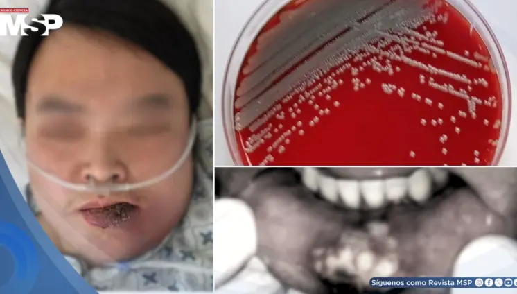 Paciente con diabetes no diagnosticada desarrolla infección facial por bacteria resistente y cetoacidosis