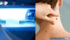 Expertos exigen prohibir las cabinas de bronceado por aumentar el riesgo de melanoma