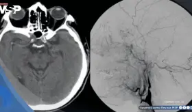 Tos violenta provocó la rotura de una arteria en el cuello y causó derrame cerebral en hombre de 57 años