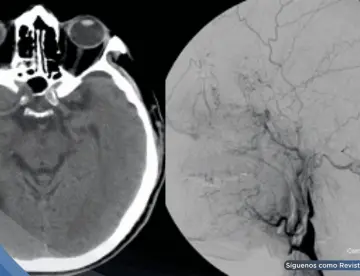 Tos violenta provocó la rotura de una arteria en el cuello y causó derrame cerebral en hombre de 57 años