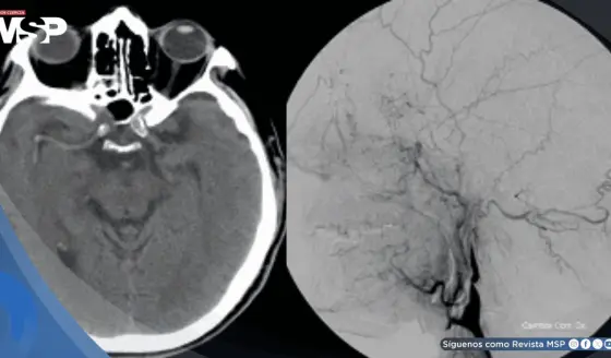 Tos violenta provocó la rotura de una arteria en el cuello y causó derrame cerebral en hombre de 57 años
