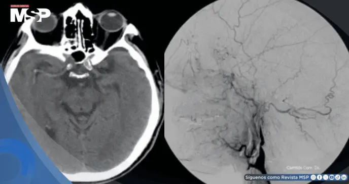 Tos violenta provocó la rotura de una arteria en el cuello y causó derrame cerebral en hombre de 57 años