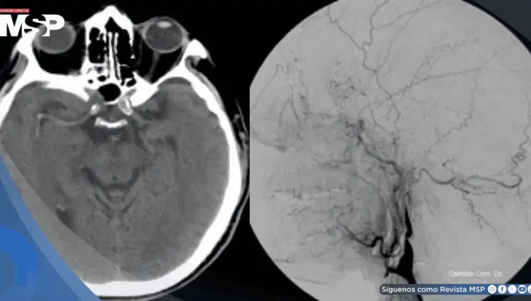 Tos violenta provocó la rotura de una arteria en el cuello y causó derrame cerebral en hombre de 57 años Tos violenta provocó la rotura de una arteria en el cuello y causó derrame cerebral en hombre de 57 años