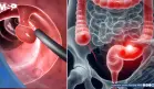 ¿Sangrado rectal? Podría ser señal temprana de cáncer colorrectal en adultos jóvenes